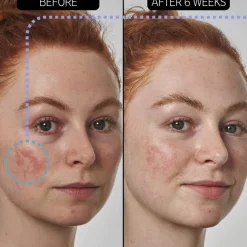 Azelaic Acid 10% Serum 30ml