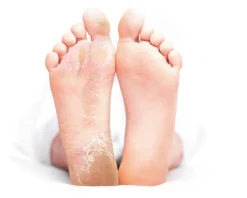 Exfoliation Foot Peel For Men 2x40ml