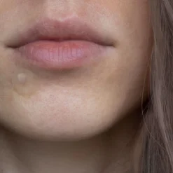 Pimple Patches 20pcs